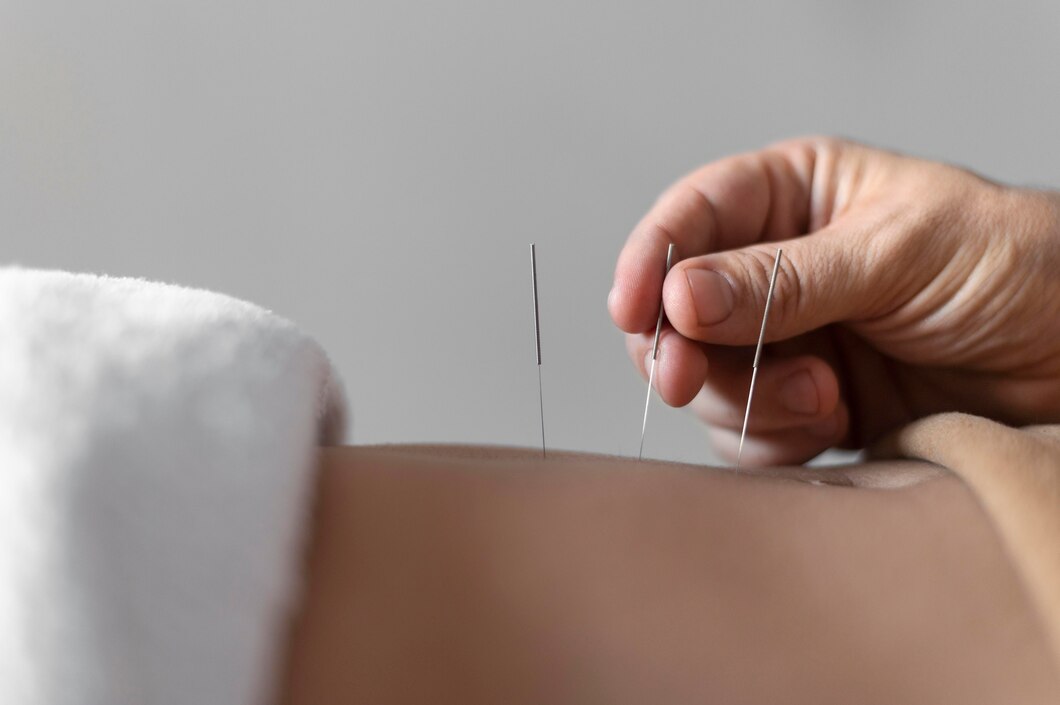 Acupuncture traditionnelle
